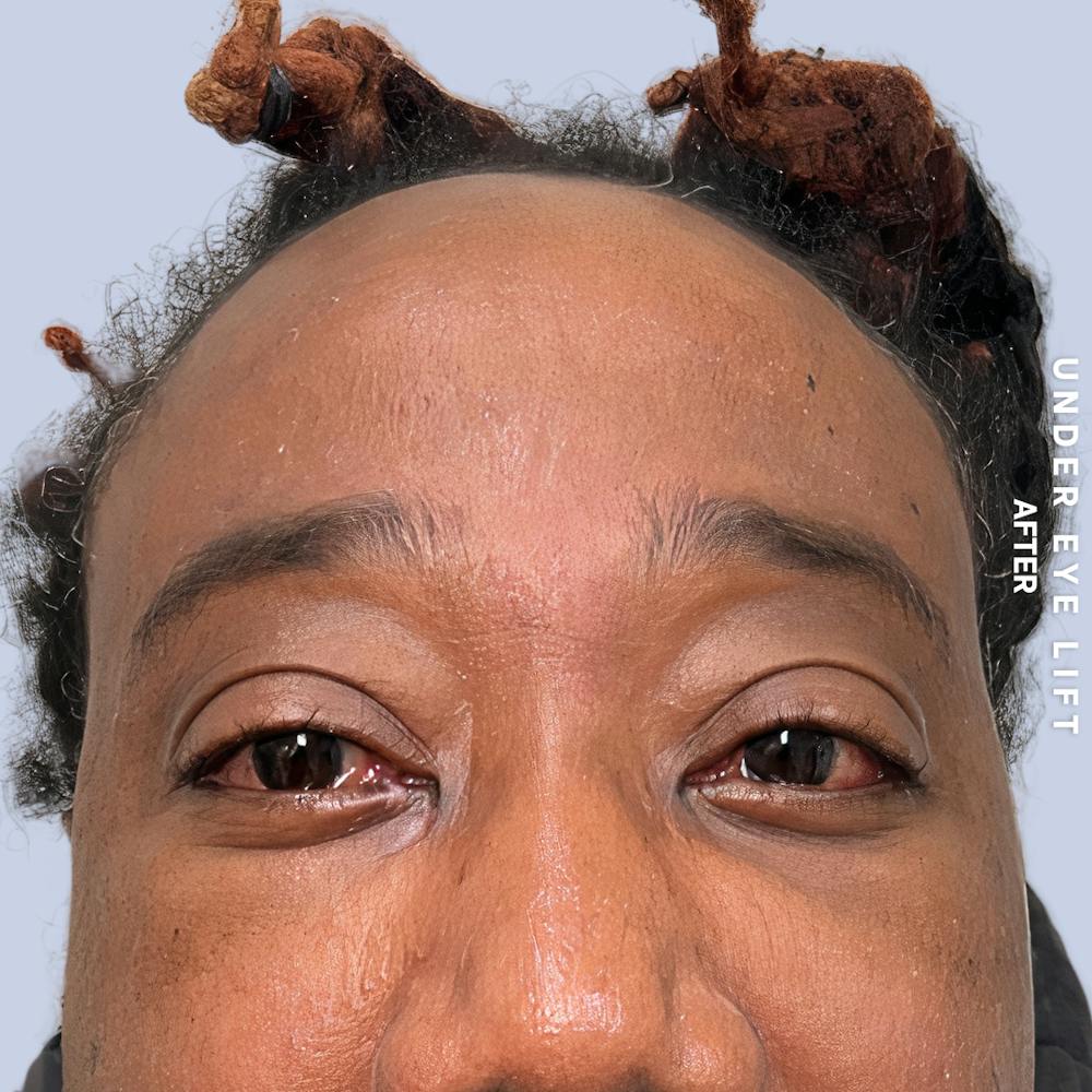 Eyes Before & After Gallery - Patient 587640 - Image 2