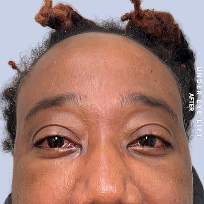 Eyes Before & After Gallery - Patient 587640 - Image 2