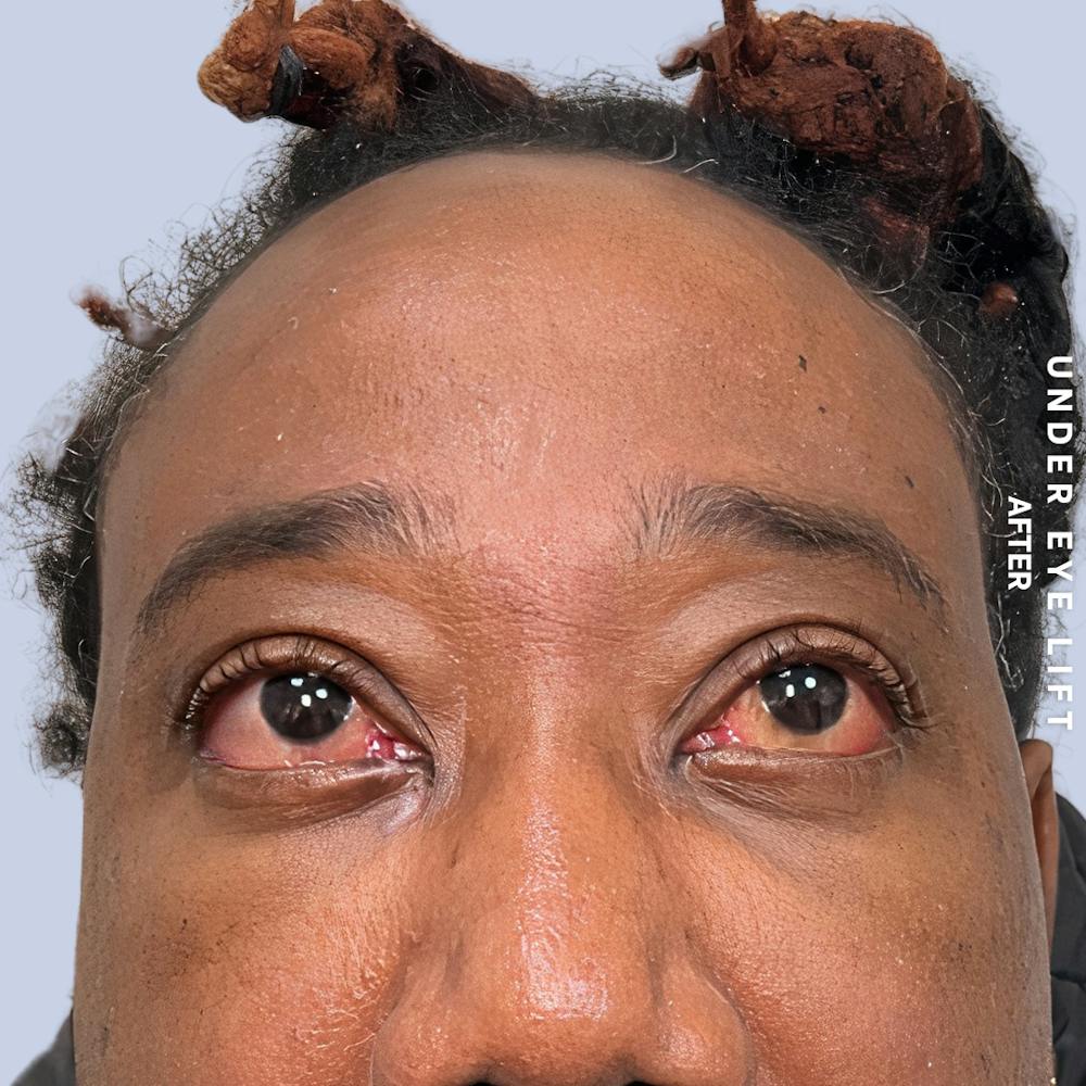 Eyes Before & After Gallery - Patient 587640 - Image 4