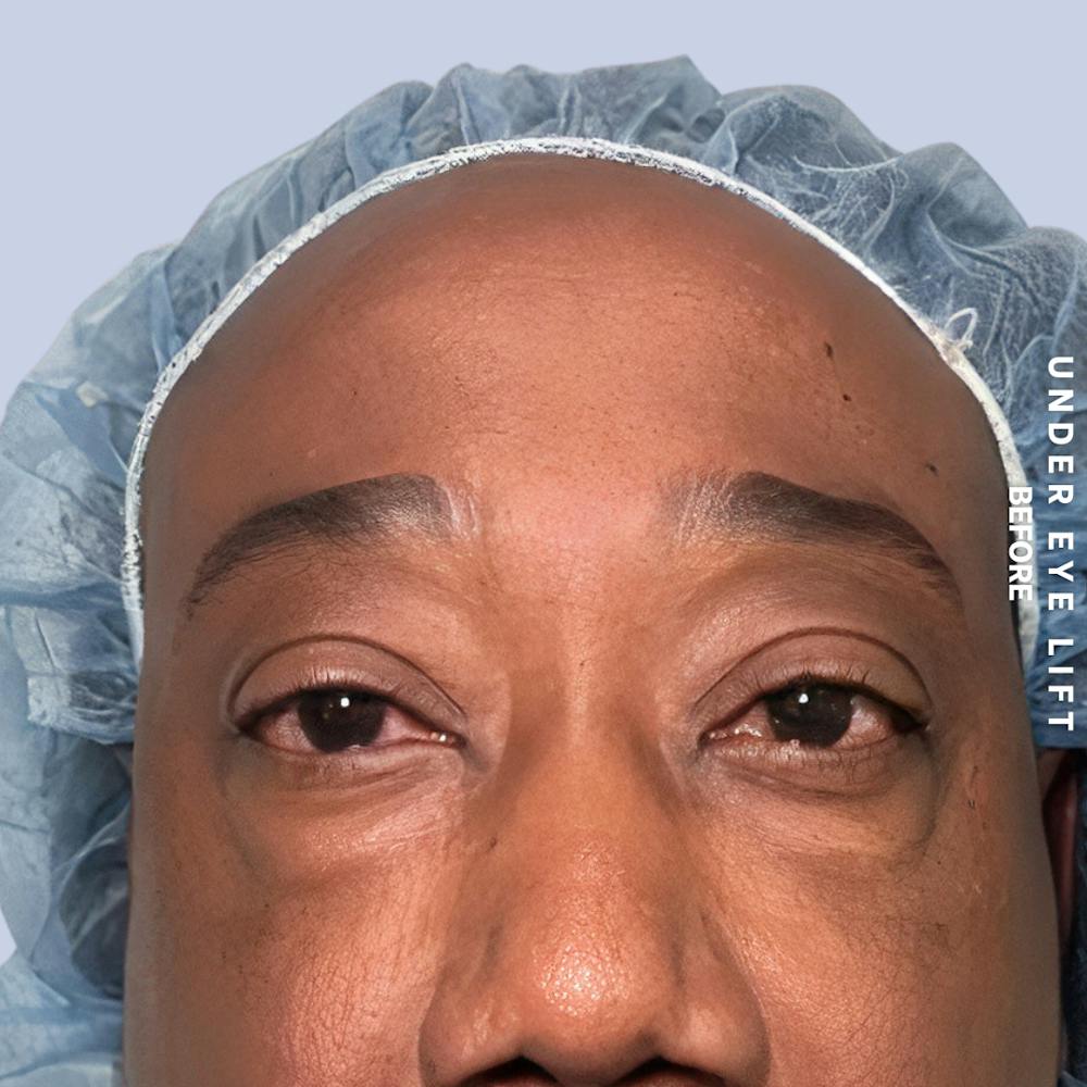 Eyes Before & After Gallery - Patient 587640 - Image 1