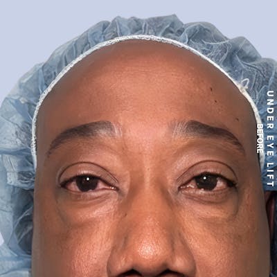 Eyes Before & After Gallery - Patient 587640 - Image 1