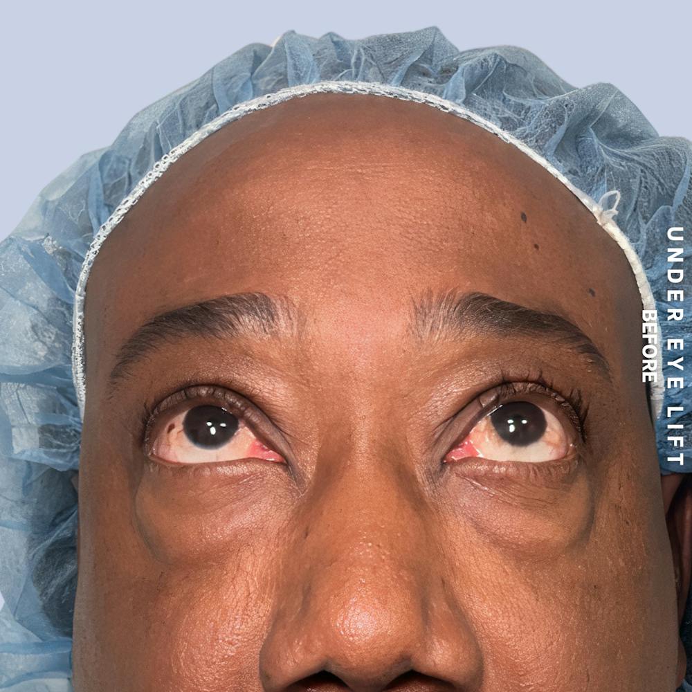 Eyes Before & After Gallery - Patient 587640 - Image 3