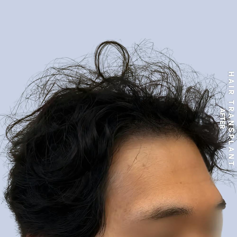 Hair Restoration Before & After Gallery - Patient 231131 - Image 2