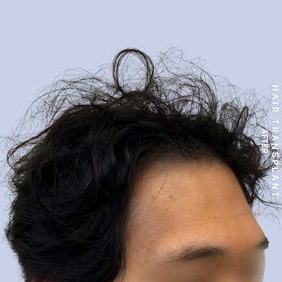 Hair Restoration Before & After Gallery - Patient 231131 - Image 2