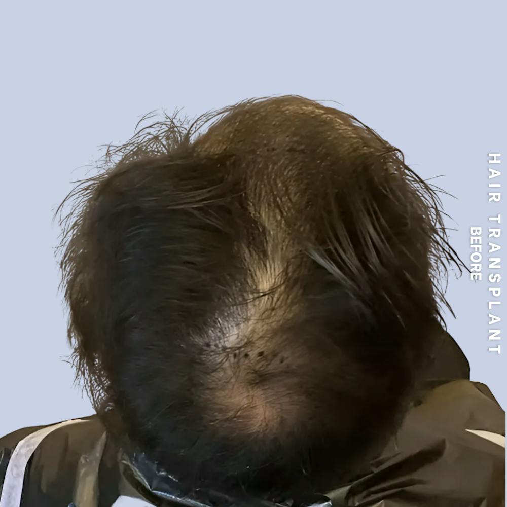 Hair Restoration Before & After Gallery - Patient 231131 - Image 3