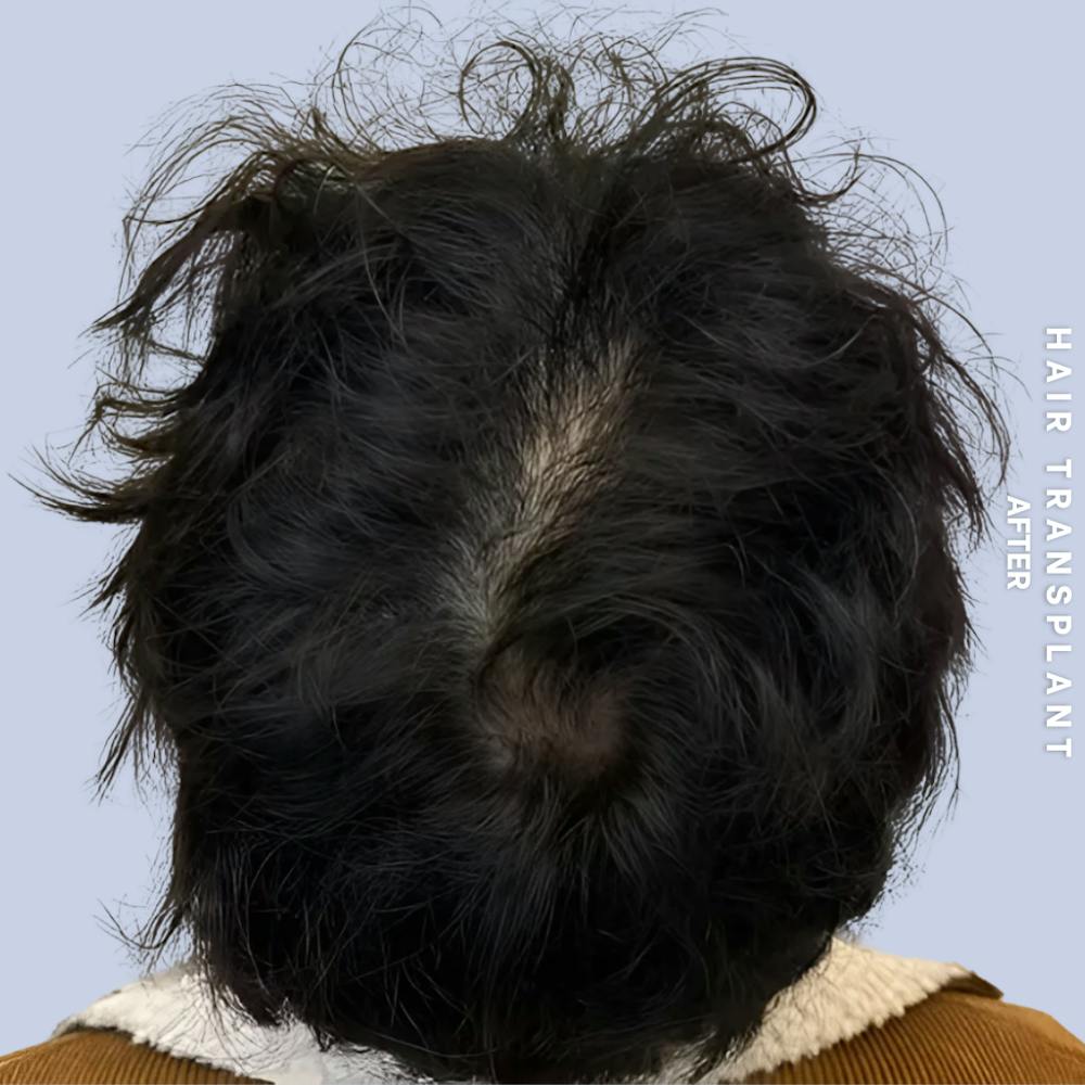 Hair Restoration Before & After Gallery - Patient 231131 - Image 4