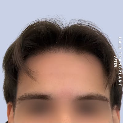 Hair Restoration Before & After Gallery - Patient 114770 - Image 4