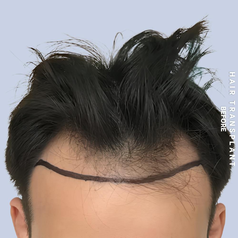 Hair Restoration Before & After Gallery - Patient 114770 - Image 5