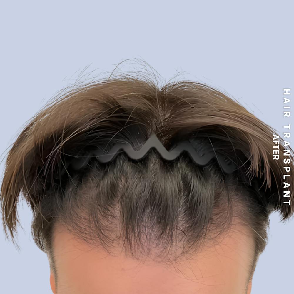 Hair Restoration Before & After Gallery - Patient 114770 - Image 6