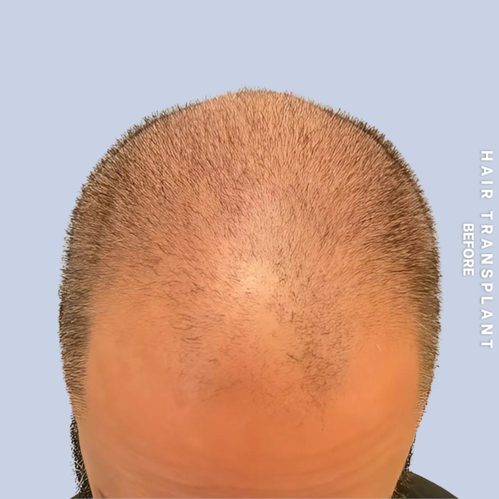 Hair Restoration Before & After Gallery - Patient 381696 - Image 1