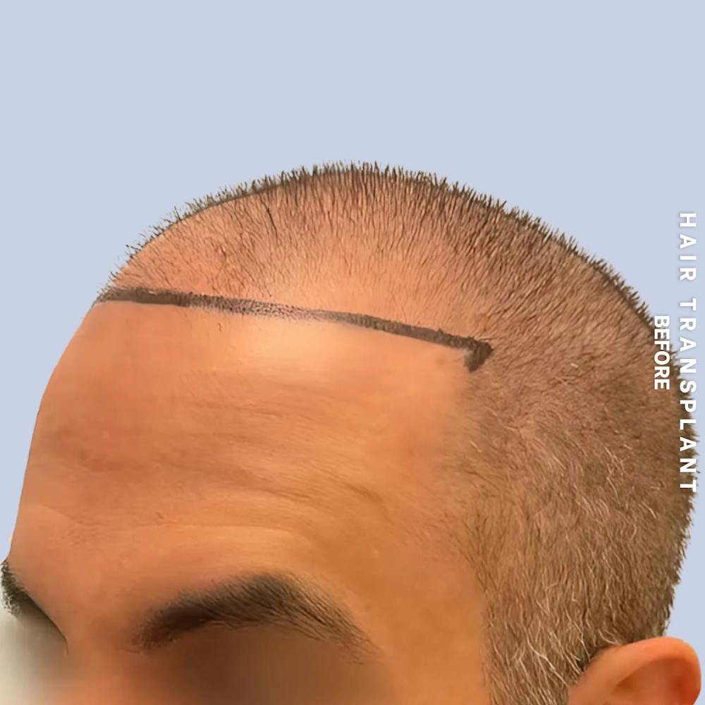 Hair Restoration Before & After Gallery - Patient 381696 - Image 3