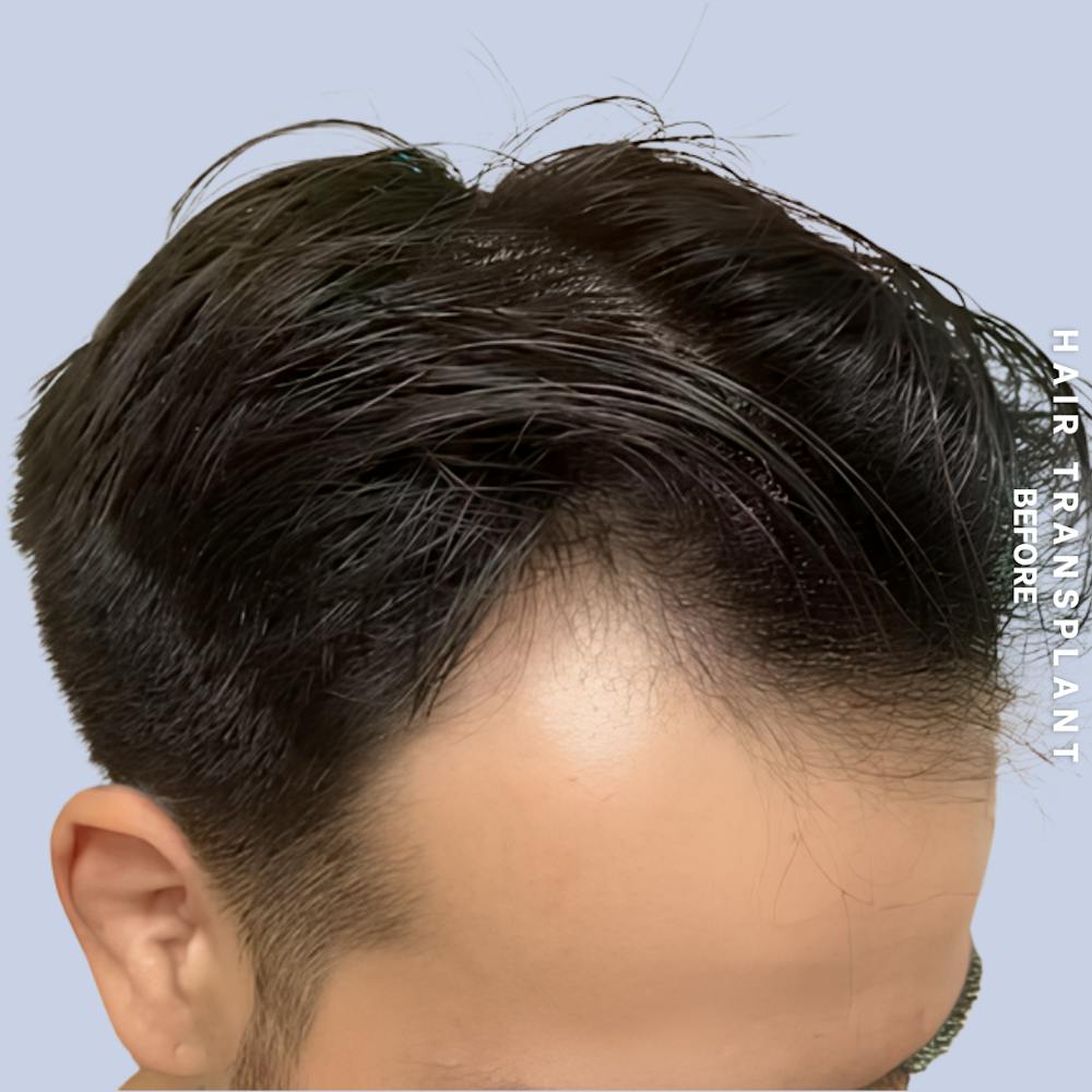 Hair Restoration Before & After Gallery - Patient 114770 - Image 1