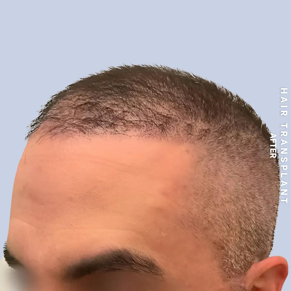 Hair Restoration Before & After Gallery - Patient 381696 - Image 4