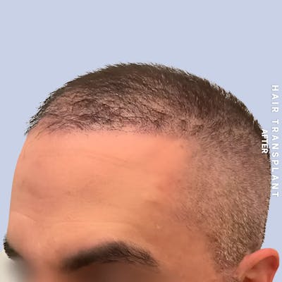 Hair Restoration Before & After Gallery - Patient 381696 - Image 4
