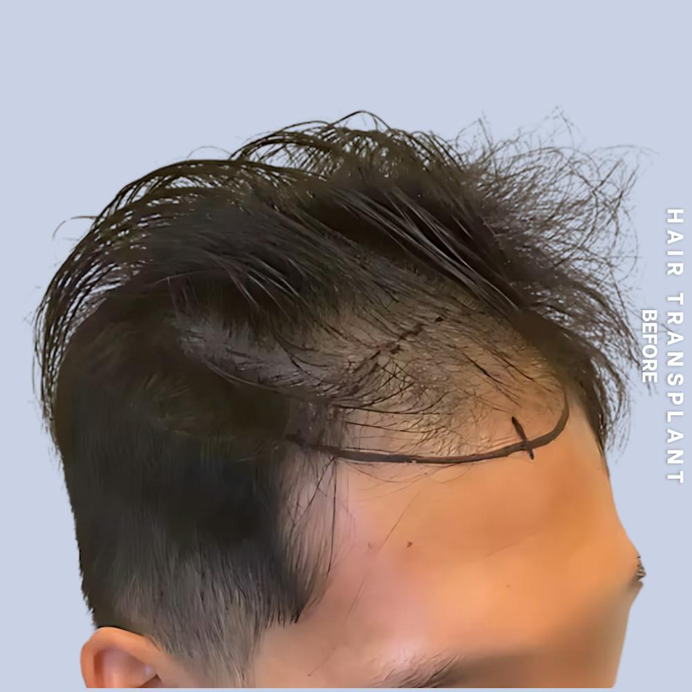 Hair Restoration Before & After Gallery - Patient 231131 - Image 1
