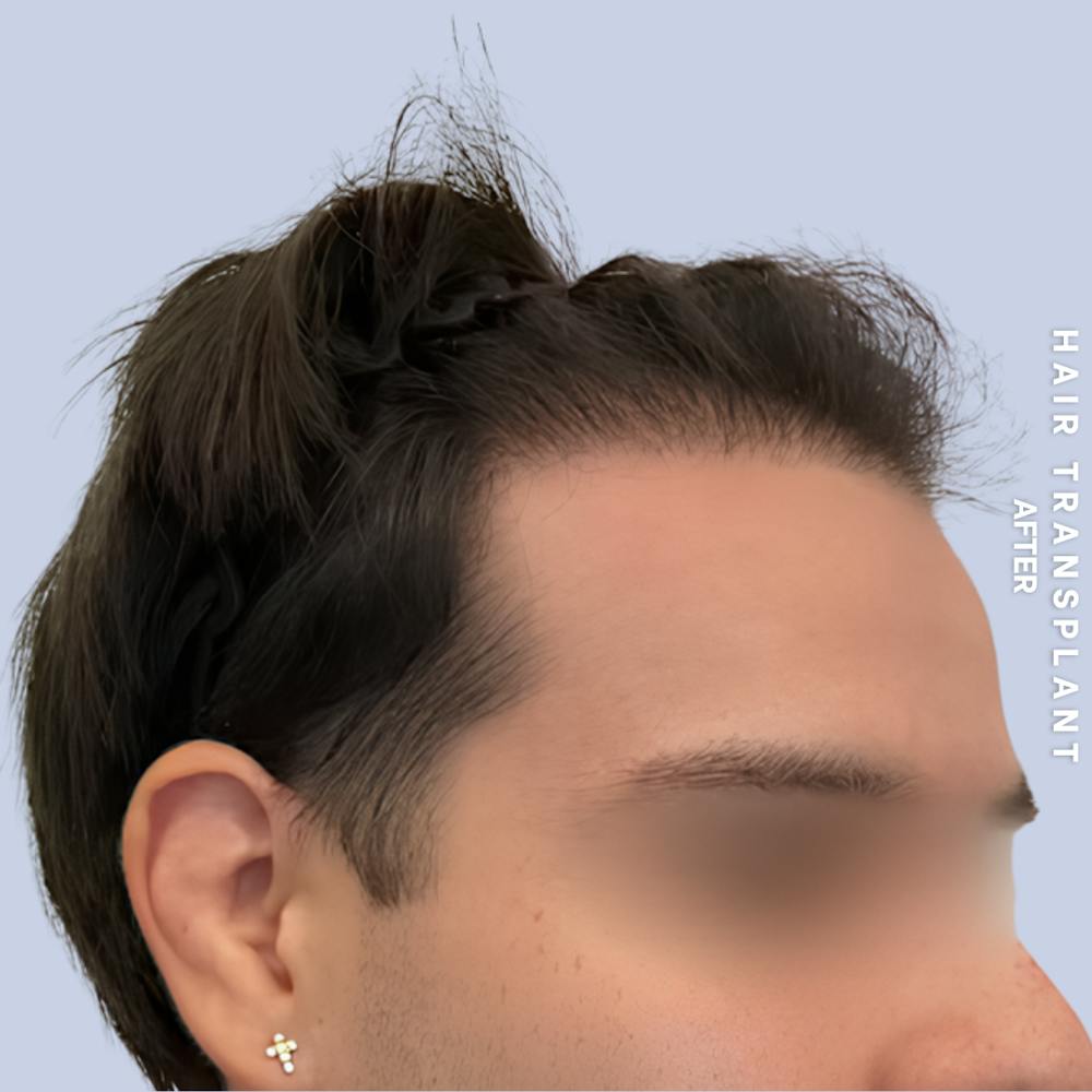 Hair Restoration Before & After Gallery - Patient 114770 - Image 2