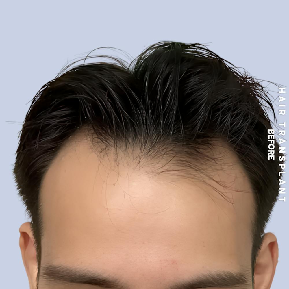 Hair Restoration Before & After Gallery - Patient 114770 - Image 3