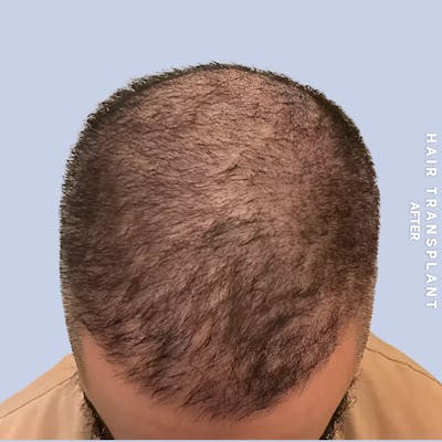 Hair Restoration Before & After Gallery - Patient 381696 - Image 2