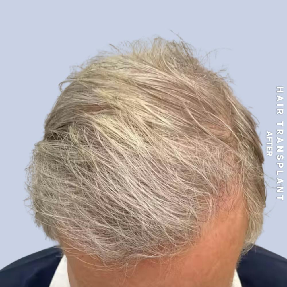 Men's Hair Before & After Gallery - Patient 405929 - Image 2