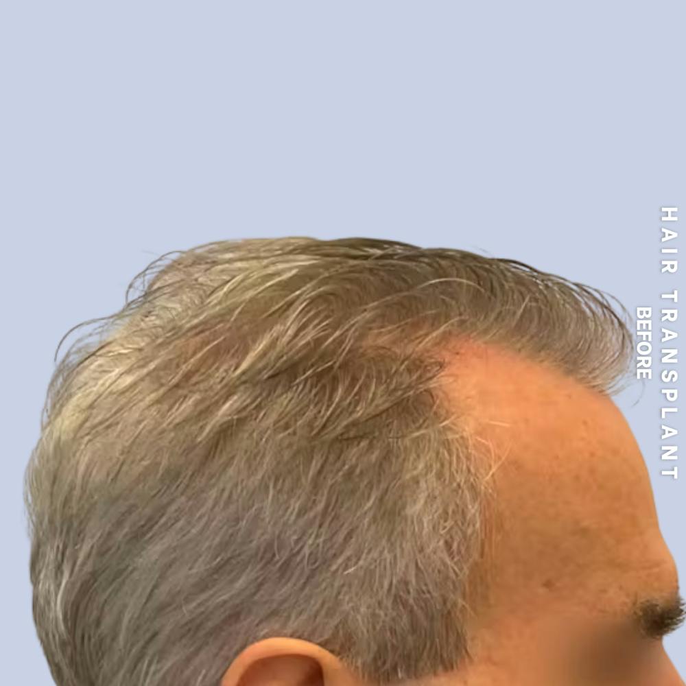 Men's Hair Before & After Gallery - Patient 405929 - Image 3