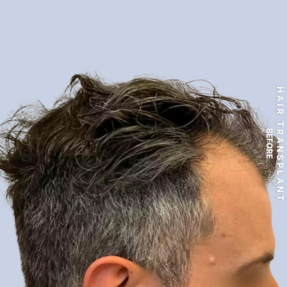 Men's Hair Before & After Gallery - Patient 209455 - Image 1