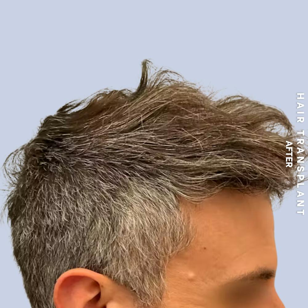 Men's Hair Before & After Gallery - Patient 209455 - Image 2