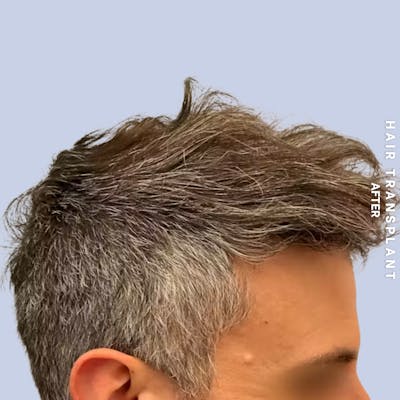 Men's Hair Before & After Gallery - Patient 209455 - Image 2