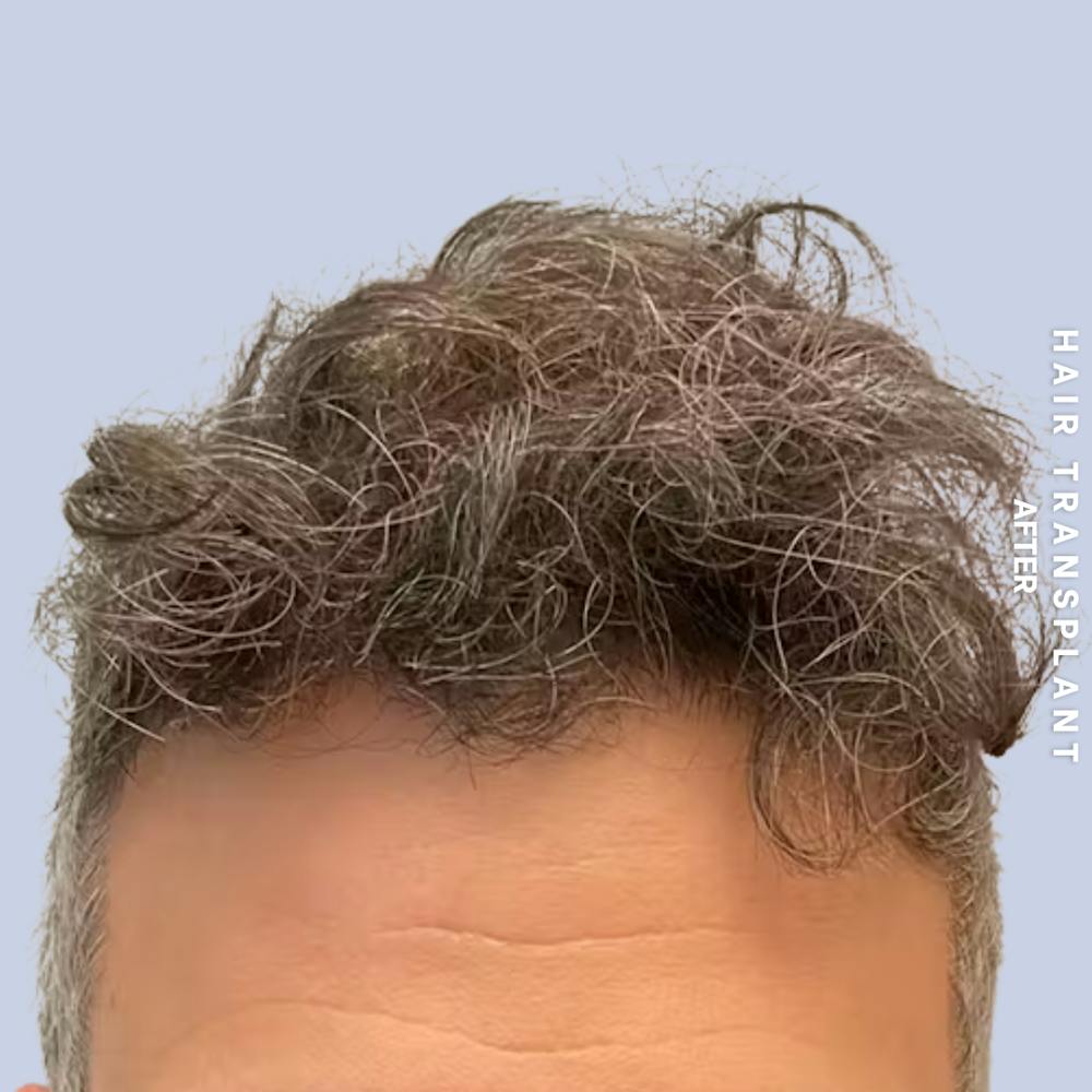 Men's Hair Before & After Gallery - Patient 209455 - Image 4