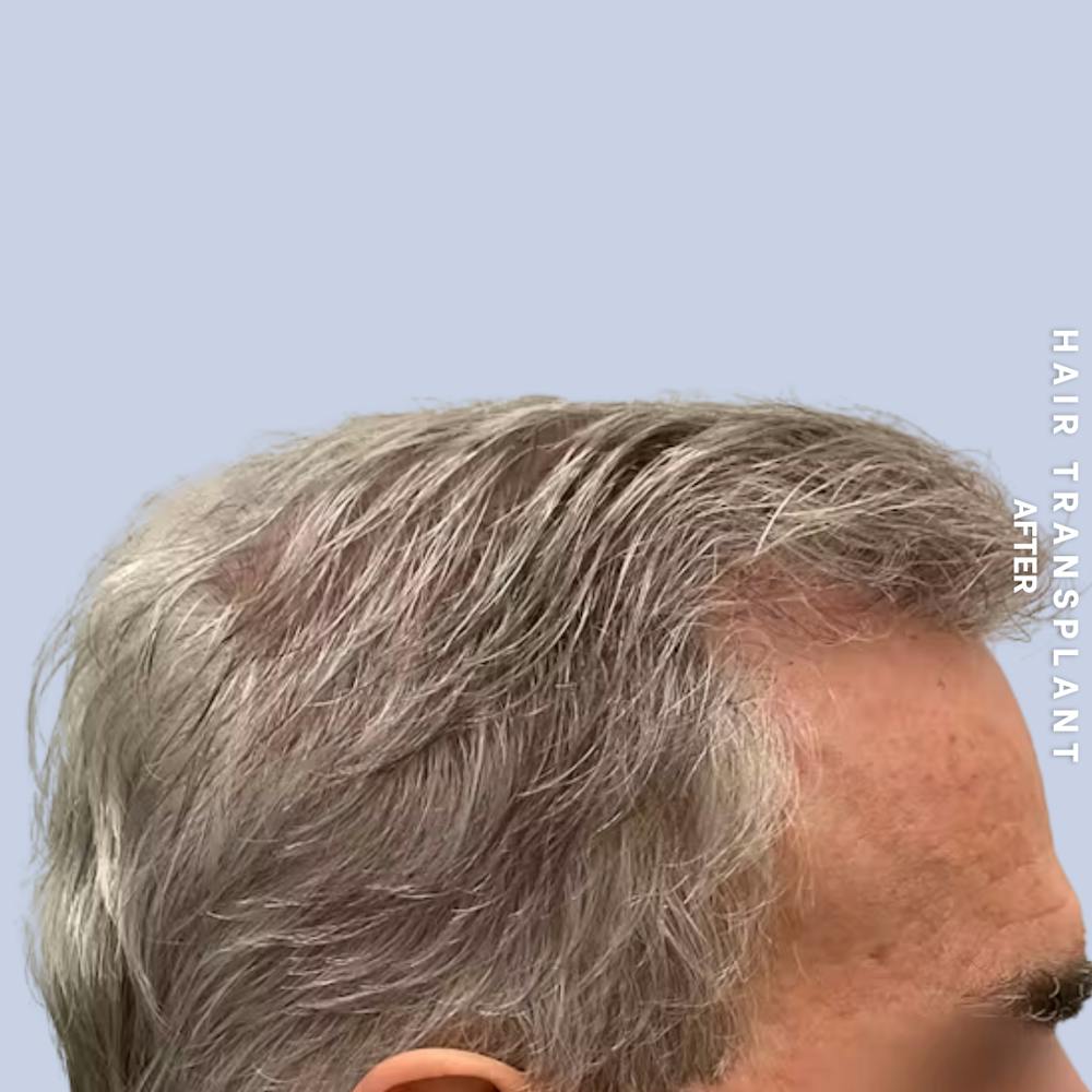 Men's Hair Before & After Gallery - Patient 405929 - Image 4