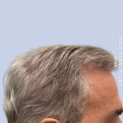 Men's Hair Before & After Gallery - Patient 405929 - Image 4