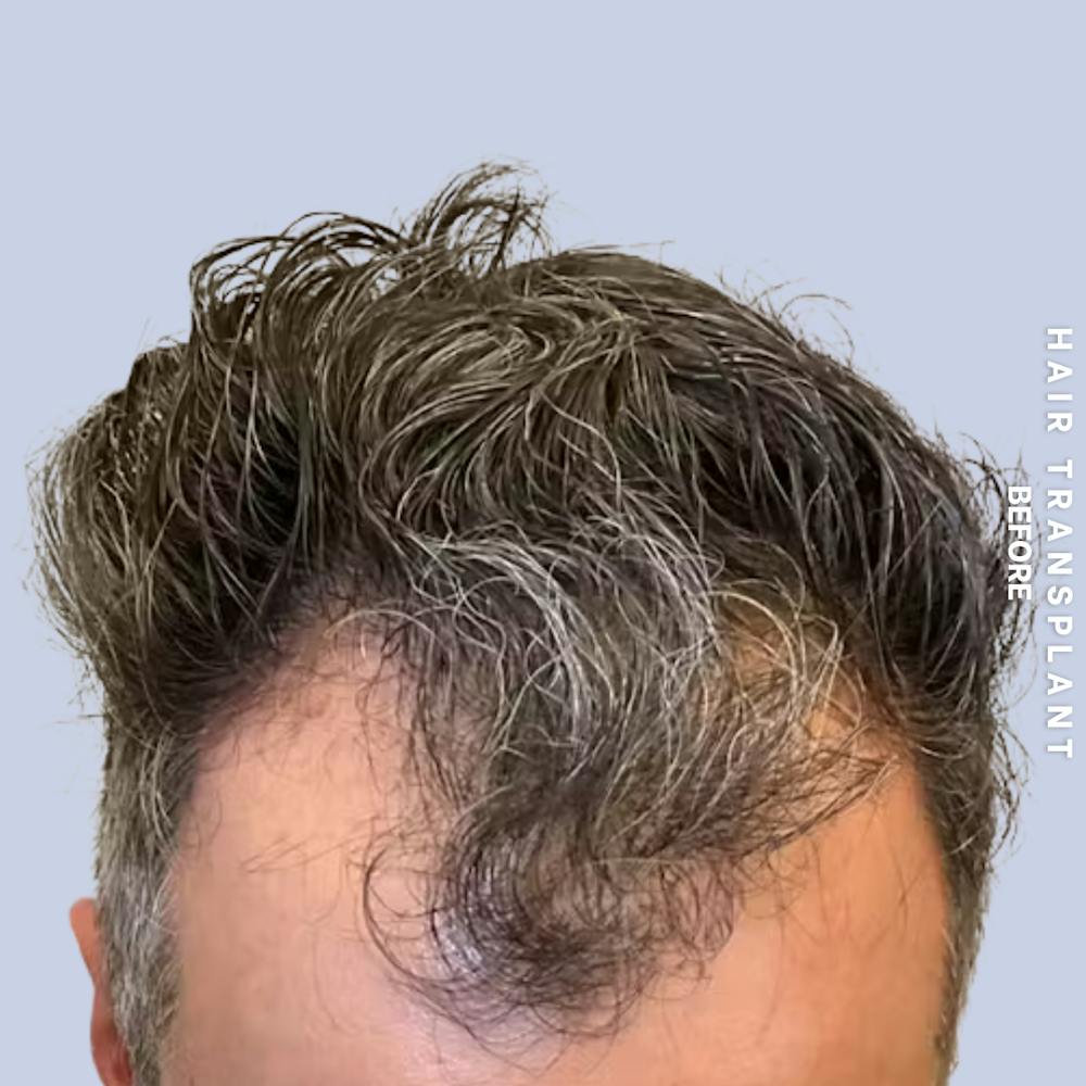 Men's Hair Before & After Gallery - Patient 209455 - Image 3