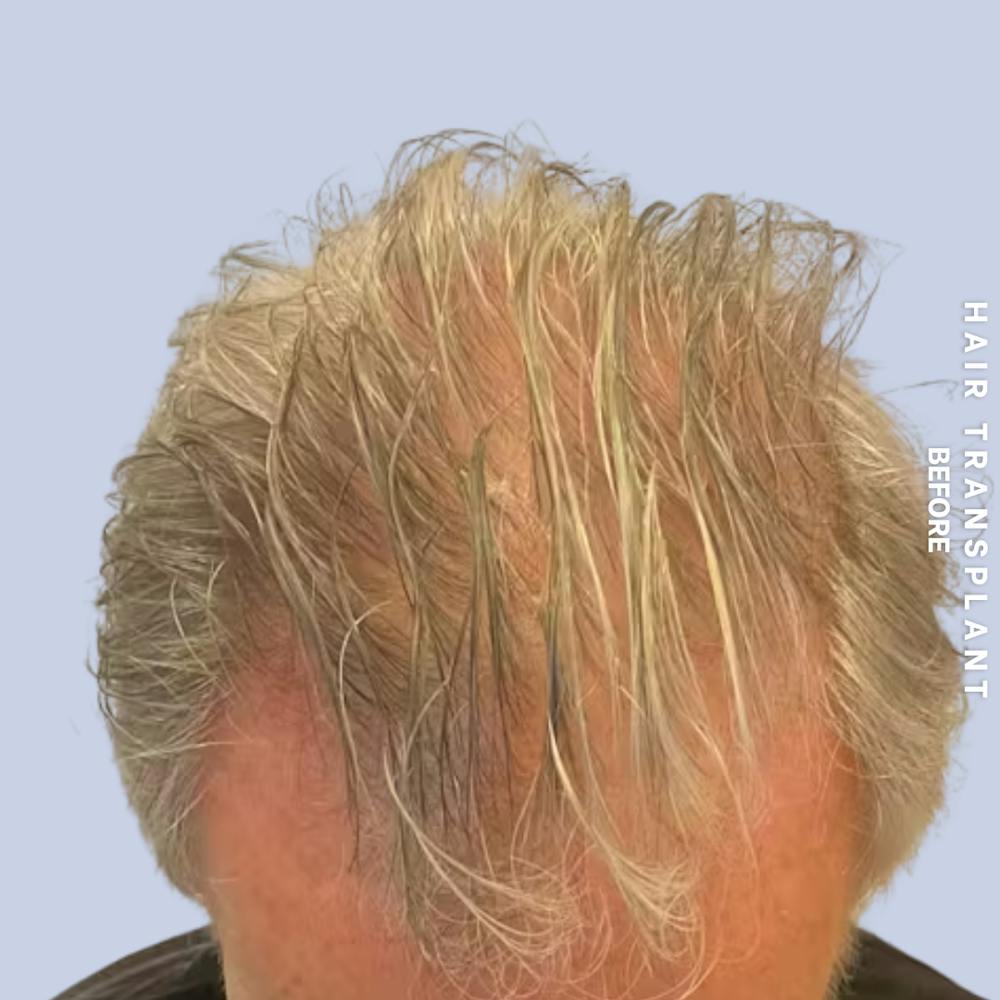 Men's Hair Before & After Gallery - Patient 405929 - Image 1