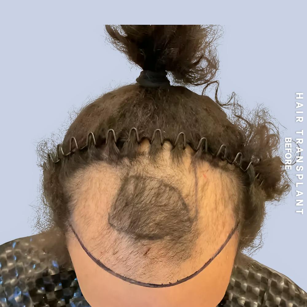Men's Hair Before & After Gallery - Patient 323909 - Image 1