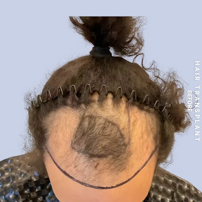 Hair Restoration Before & After Gallery - Patient 777254 - Image 1