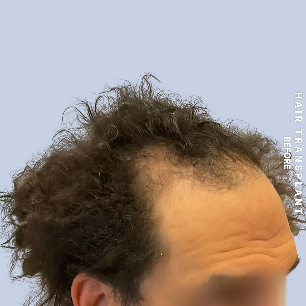 Men's Hair Before & After Gallery - Patient 323909 - Image 3