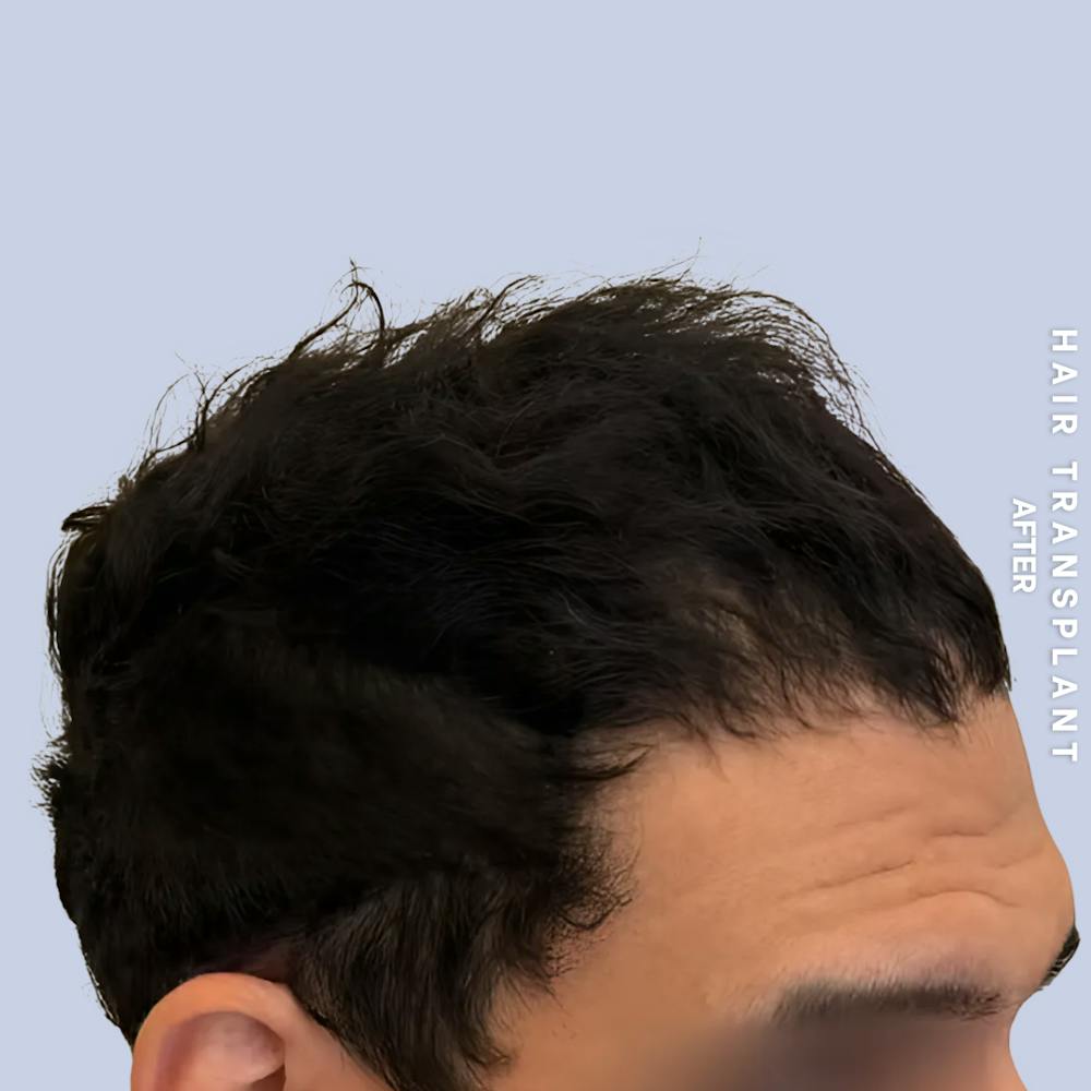 Men's Hair Before & After Gallery - Patient 323909 - Image 4