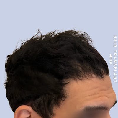 Men's Hair Before & After Gallery - Patient 323909 - Image 4