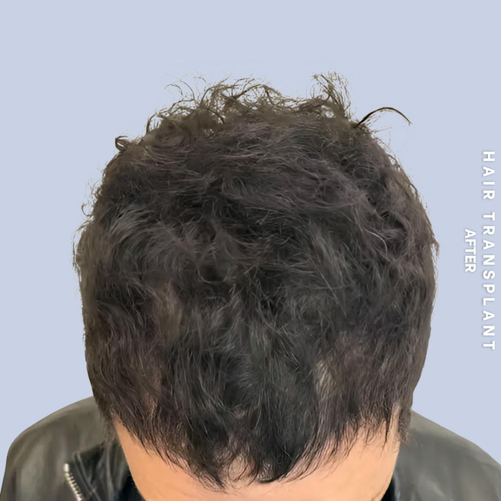 Men's Hair Before & After Gallery - Patient 323909 - Image 2