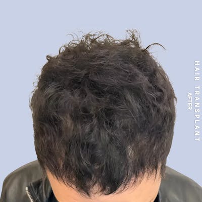 Men's Hair Before & After Gallery - Patient 323909 - Image 2