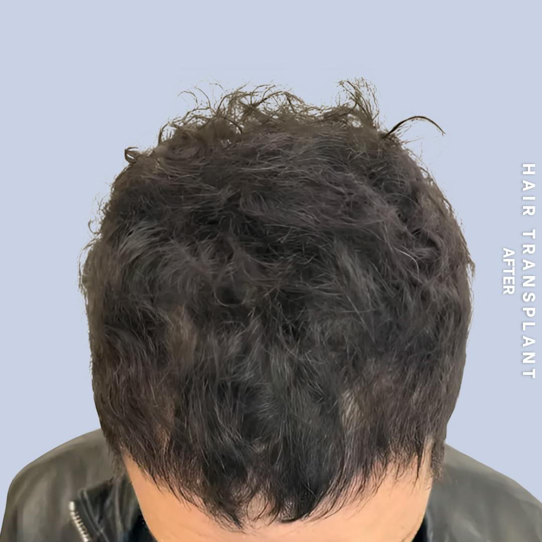 Hair Restoration Before & After Gallery - Patient 777254 - Image 2