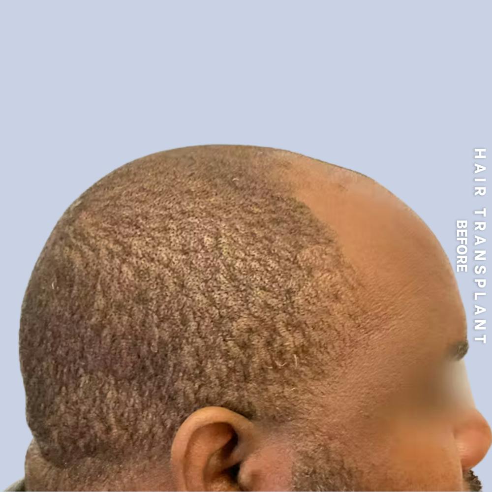 Hair Restoration Before & After Gallery - Patient 380309 - Image 1