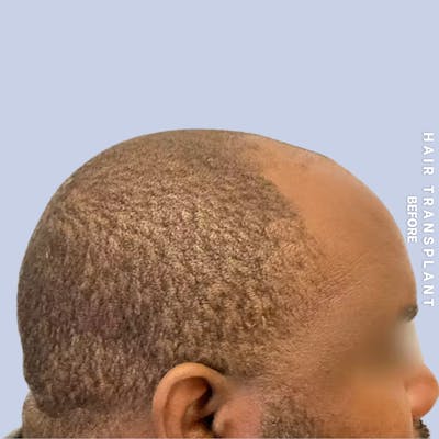 Hair Restoration Before & After Gallery - Patient 380309 - Image 1