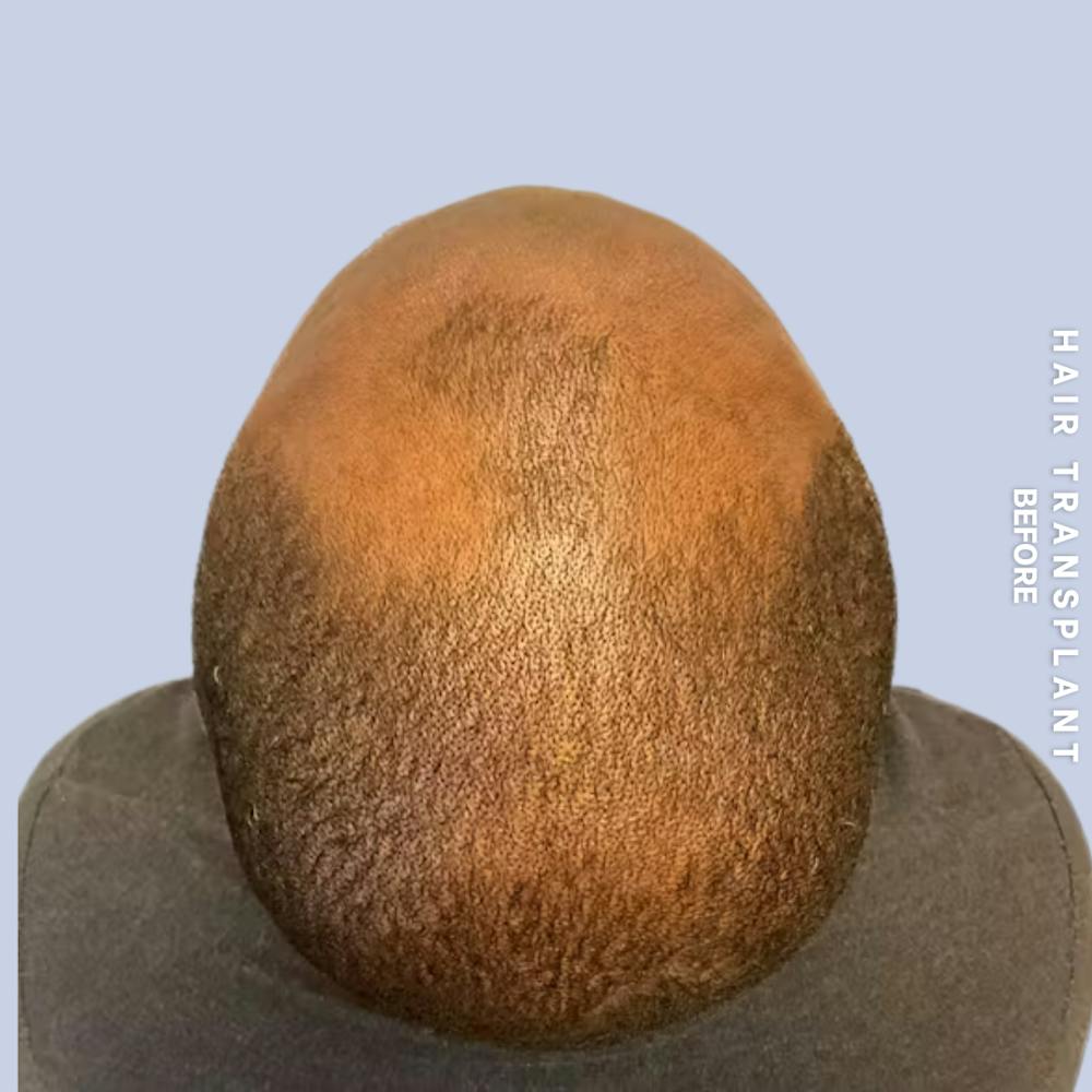 Hair Restoration Before & After Gallery - Patient 380309 - Image 3