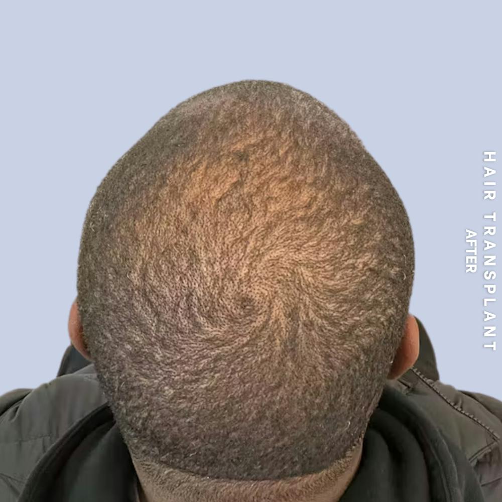 Hair Restoration Before & After Gallery - Patient 380309 - Image 4