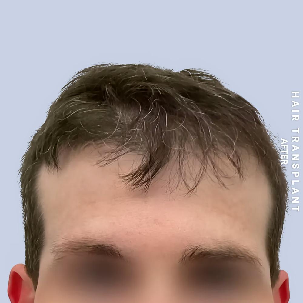Hair Restoration Before & After Gallery - Patient 334805 - Image 2