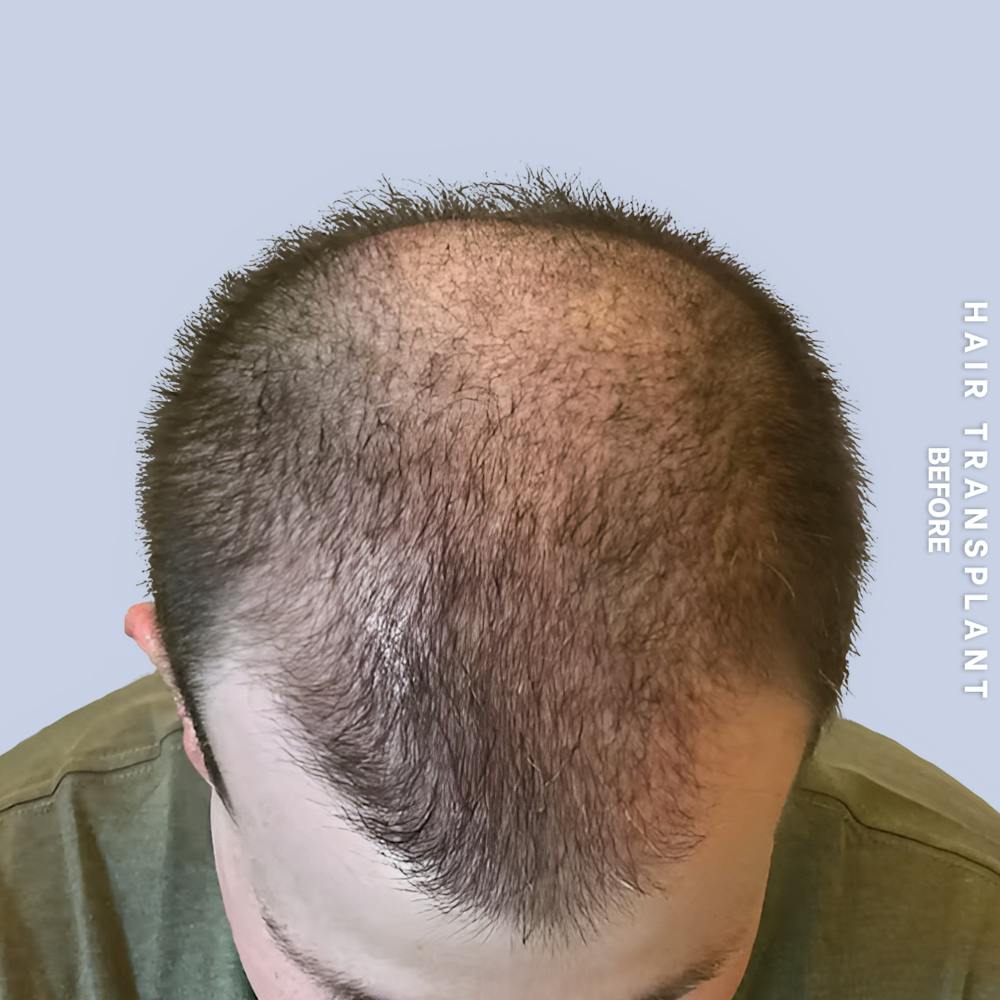 Hair Restoration Before & After Gallery - Patient 334805 - Image 3