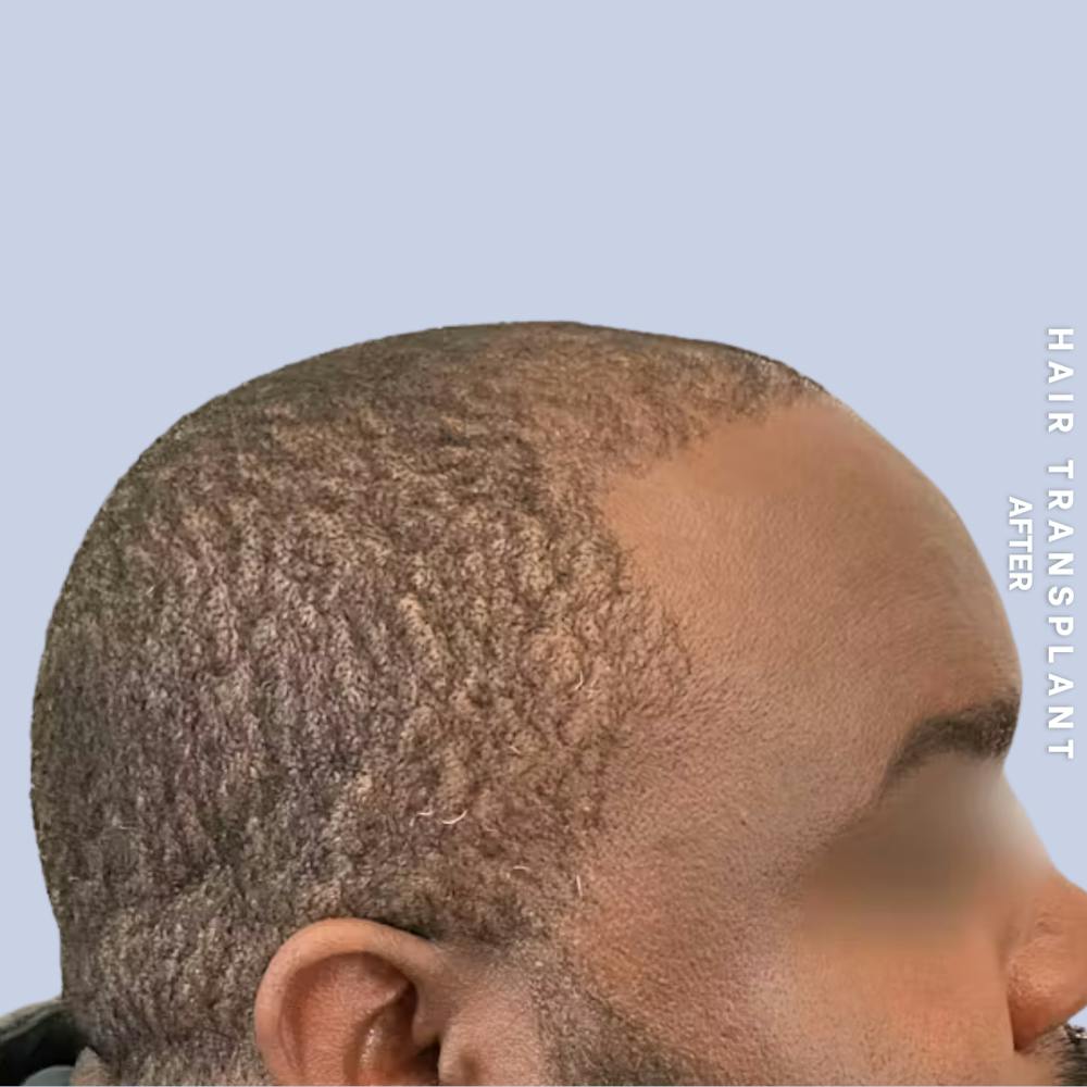 Hair Restoration Before & After Gallery - Patient 380309 - Image 2