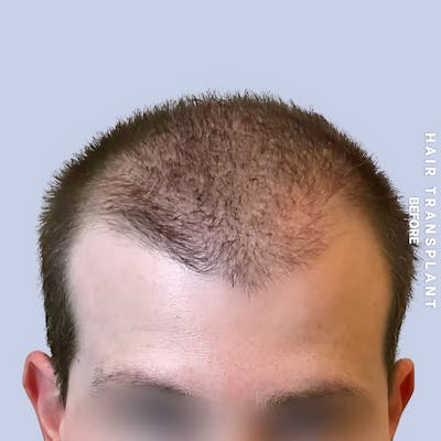 Hair Restoration Before & After Gallery - Patient 334805 - Image 1