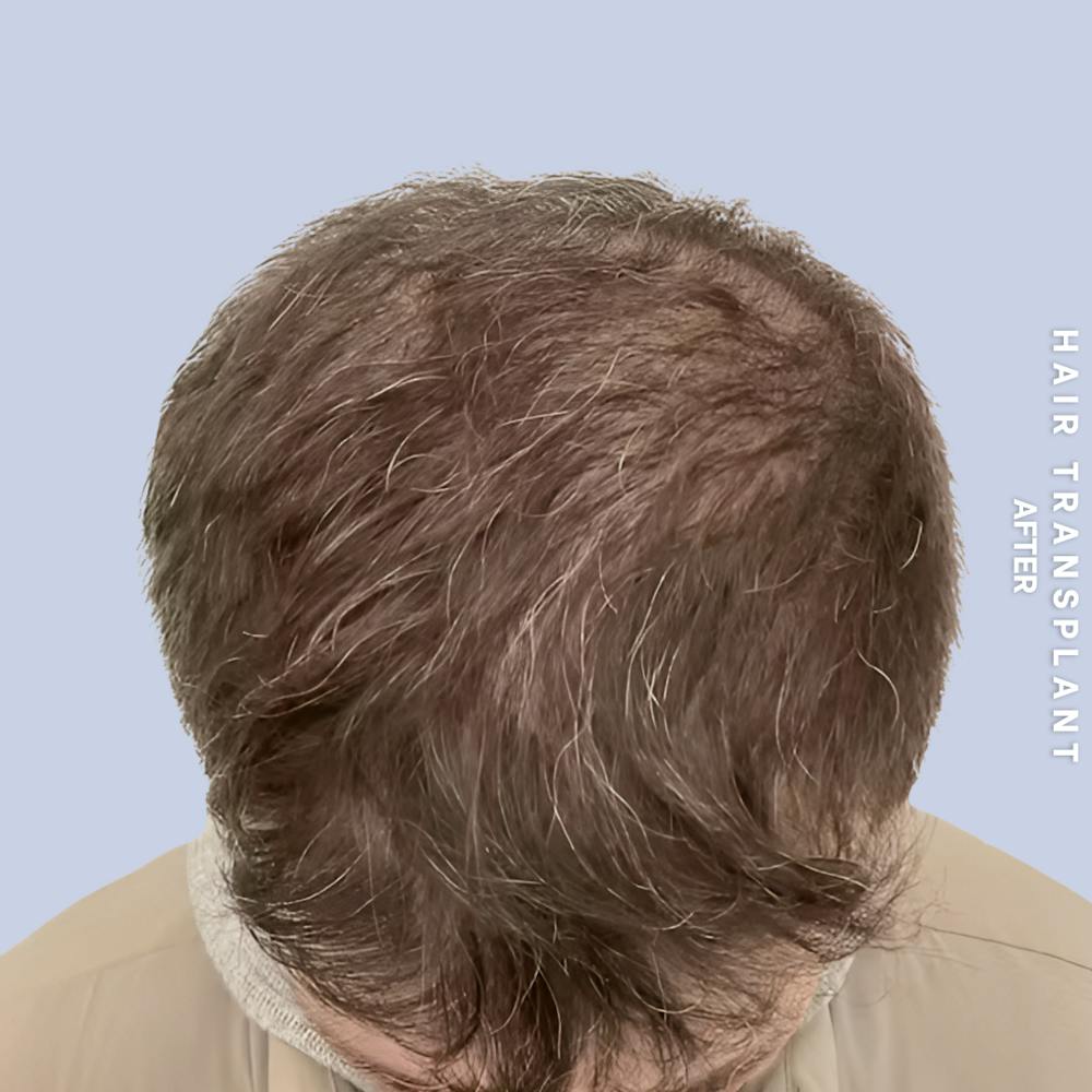 Hair Restoration Before & After Gallery - Patient 334805 - Image 4