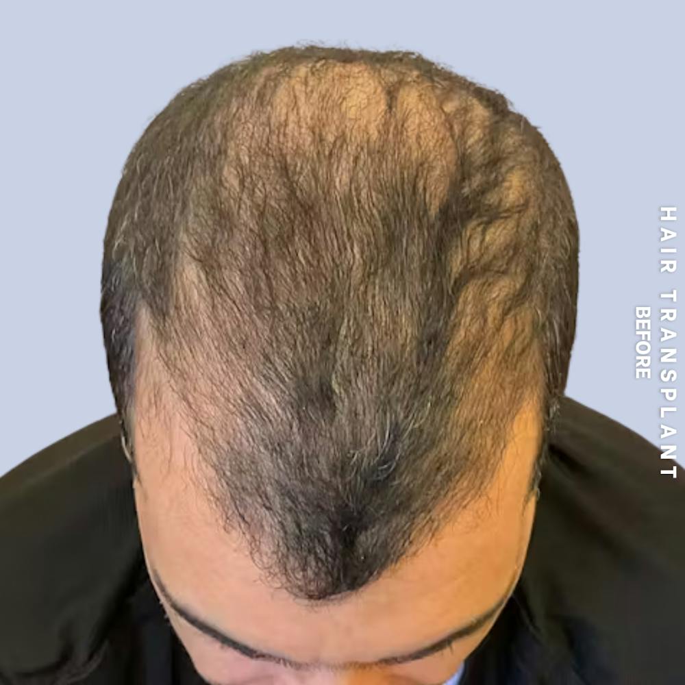 Hair Restoration Before & After Gallery - Patient 223060 - Image 1